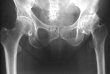 Ruth, Follow up thumbnail of an x-ray, Limb Lengthening, total hip replacement, THR