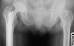 Alvin, Follow up thumbnail of an x-ray, Limb Lengthening, total hip replacement, THR