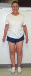 Ruth, Follow up thumbnail image, Limb Lengthening, total hip replacement, THR