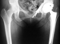 Karen, Post-op thumbnail of an x-ray, Limb Lengthening, total hip replacement, THR, fractured acetabulum, fractured hip socket