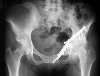 Karen, Pre-op thumbnail of an x-ray, Limb Lengthening, fractured acetabulum, fractured hip socket