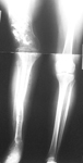 Colleen, Post-Op thumbnail of an x-ray, Limb Lengthening, double level osteotomy, knee valgus, equinovarus deformity of foot and ankle