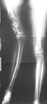 Colleen, Pre-Op thumbnail of an x-ray, Limb Lengthening, bone tumor, damaged to growth plate, valgus deformity, equinovarus deformity, foot deformity