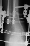 Richard, Follow up thumbnail of an x-ray, Limb Lengthening, ankle fusion, ankle arthrodesis, ilizarov method