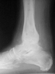 Richard, Follow up thumbnail of an x-ray, Limb Lengthening, ankle fusion, ankle arthrodesis, mobility, pain relief