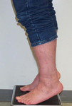 Richard, Follow up thumbnail image, Limb Lengthening, ankle fusion, ankle arthrodesis, mobility, pain relief