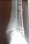 Richard, Pre-op thumbnail of an x-ray, Limb Lengthening, ankle fracture, hardware fail, bone infection, ankle injury