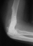 Bill, Follow up thumbnail of an x-ray, Limb Lengthening, humerus healed, return to active lifestyle, nonunion