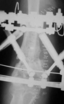 Bill, Post-Op thumbnail of an X-ray, Limb Lengthening, repaired nonunion, distal humerus nonunion, ilizarov/taylor spatial frame