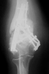 Bill, Pre-Op thumbnail of an x-ray, Limb Lengthening, distal humerus fracture, painful nonunion, broken internal hardware