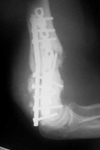 Bill, Pre-Op thumbnail of an x-ray, Limb Lengthening, distal humerus fracture, painful nonunion, broken internal hardware
