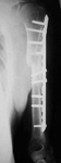 Max, Follow up thumbnail of an x-ray, Limb Lengthening, Humerus Nonunion, humerus healed