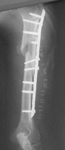 Max, Post-op thumbnail of an x-ray, Limb Lengthening, Humerus Nonunion, locking compression plate, grafton bone graft substitute material