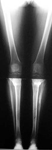 Michael, Follow up thumbnail of an x-ray, Limb Lengthening, Bowlegs, deformity corrected, slowed arthritis