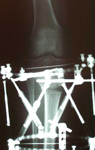 Michael, Post-op thumbnail of an x-ray, Limb Lengthening, Bowlegs, gradual opening correction, correction of deformity