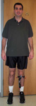 Michael, Post-op thumbnail image, Limb Lengthening, Bowlegs, gradual opening correction, correction of deformity