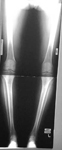 Michael, Pre-op thumbnail of an x-ray, Limb Lengthening, Bowlegs, Bilateral Tibial Vara, Mal-alignment