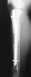 James, Follow up thumbnail of an x-ray, Limb Lengthening, Stature Lengthening, dwarfism
