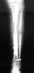 James, post op thumbnail of an x-ray, Limb Lengthening, Stature Lengthening, osteotomies, LATN technique 