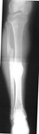Marcel, Follow up thumbnail of an x-ray, Limb Lengthening, bone healed, deformity correction, length equalization