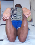 Marcel, Follow up thumbnail image, Limb Lengthening, bone healed, deformity correction, length equalization