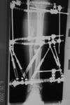 Marcel, Post-op thumbnail of an x-ray, Limb Lengthening, tibia fracture, osteotomy lengthening, deformity correction, ilizarov/taylor-spatial frame