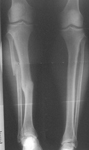 Marcel, Pre-op thumbnail of an x-ray, Limb Lengthening, tibia fracture, deformity shortening, back pain