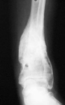 Maria, Follow up thumbnail of an x-ray, Limb Lengthening, repair of tibia nonunion, correction of deformity, returned to active schedule