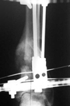 Maria, Post-op thumbnail of an x-ray, Limb Lengthening, repair of tibia nonunion, correction of deformity