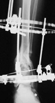 Maria, Post-op thumbnail of an x-ray, Limb Lengthening, repair of tibia nonunion, correction of deformity