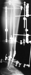 Juan, Post-op thumbnail of an x-ray, Limb Lengthening, Distal Tibia fracture, ilizarov frame