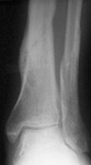 Juan, Post-op thumbnail of an x-ray, Limb Lengthening, Distal Tibia fracture, ilizarov frame