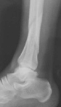 Juan, Pre-op thumbnail of an X-ray, Limb Lengthening, Distal Tibia fracture, compartment syndrome