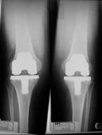 Ema, Post-op thumbnail of an X-ray, Limb Lengthening, bilateral knee replacement