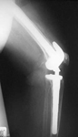Virigina, Follow up thumbnail of an X-ray, Limb Lengthening, Valgus, Knock knee, deformity correction, Total Knee Replacement