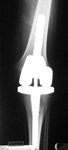 Edith, Follow up thumbnail of an X-ray, Limb Lengthening, Total Knee Replacement