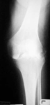Edith, Pre Op thumbnail of an X-ray, Limb Lengthening, knee infection