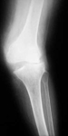 Virigina, Pre-Op thumbnail of an X-ray, Limb Lengthening, Valgus, Knock knee, deformity