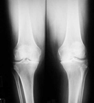Ema, Pre-op thumbnail of an X-ray, Limb Lengthening, arthritis, knee pain, vargus, bowlegged, deformity