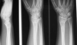 Eve, Follow up thumbnail of an x-ray, Limb Lengthening, wrist deformity correction, pediatrics
