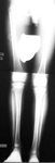 Jacob, Pre-Op thumbnail of an x-ray, Limb Lengthening, 2 inch leg length discrepancy