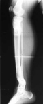 Sheila, Follow up thumbnail of an X-ray, Limb Lengthening, double-level osteotomy, tibia lengthening, deformity corrected