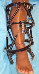Sheila, Post-Op thumbnail Image, Limb Lengthening, double level osteotomy, taylor spatial frame