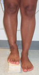 Sheila, Pre-Op thumbnail Image, Limb Lengthening, shortening, varus flexion deformity, tibia