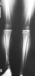Sheila, Pre-Op thumbnail of an x-ray, Limb Lengthening, shortening, varus flexion deformity, tibia