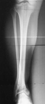 Sheila, Pre-Op thumbnail of an x-ray, Limb Lengthening, shortening, varus flexion deformity, tibia