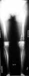 Nancy, Follow up thumbnail of an x-ray, Limb Lengthening, deformity corrected, weightbearing exercise, arthritis prevention, pain relieved