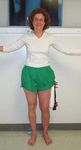 Nancy, Post-op thumbnail Image, Limb Lengthening, femur osteotomy, gradual lengthening, EBI frame