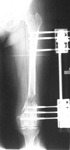 Nancy, Post-op thumbnail of an x-ray, Limb Lengthening, femur osteotomy, gradual lengthening, EBI frame