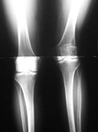 Nancy, Pre-op thumbnail of an x-ray, Limb Lengthening, deformity correction, valgus, knock-knee deformity, arthritis, knee pain